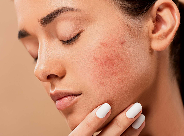 TEEN ACNE