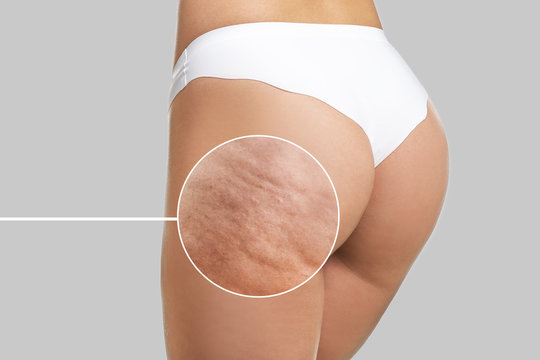 Appearance Of Cellulite
