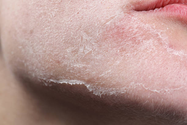 dry skin can lead to cracking and bleeding