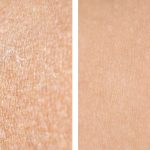 What Peel Options Work Best for Sensitive Skin?