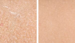What Peel Options Work Best for Sensitive Skin?